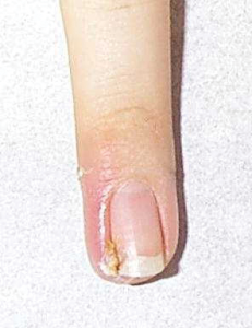 Acute paronychia. Visible swelling, erythema, and discharge along the nail fold, yet the nail itself is intact.