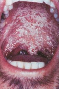 Candidiasis