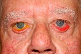 Conjunctiva are red from air exposure and irritation.