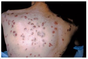 Whereas some patients may have lesions that remain flat, others experience extensively disseminated, raised lesions with edema.