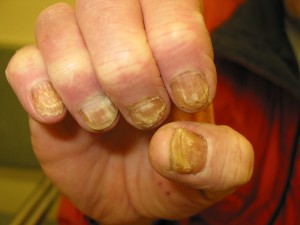 Onychomycosis: fingernails