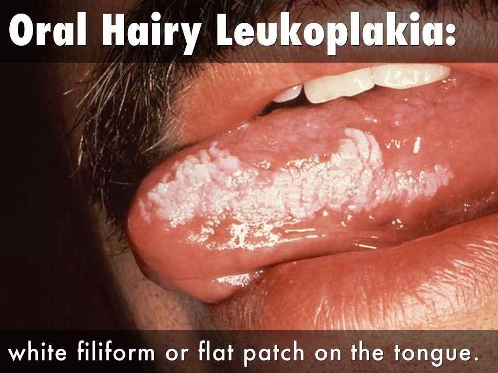 Hairy Leukoplakia Of Tongue 89