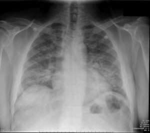 Diffuse, bilateral, interstitial infiltrates
