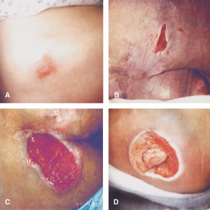 Pressure ulcer staging. (A) Stage I, erythema; (B) Stage II, breakdown of the dermis; (C) Stage III, full thickness skin breakdown; (D) Stage IV, bone, muscle, and supporting tissue involved.