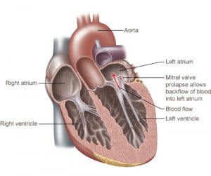 mitral-valve-prolapse-life-insurance-quotes (1)