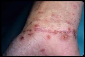 Scabies on the wrist (common site of infection)