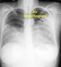 An air bronchogram appears when an infiltrate surrounds a peripheral bronchi, and is thus important in establishing lung consolidation.