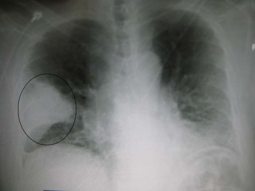 A chest X-ray showing a very prominent wedge-shape area of airspace consolidation in the right lung characteristic of bacterial pneumonia.