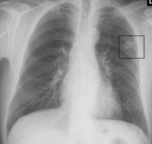 Chest X-ray showing a solitary pulmonary nodule (indicated by a black box) in the left upper lobe