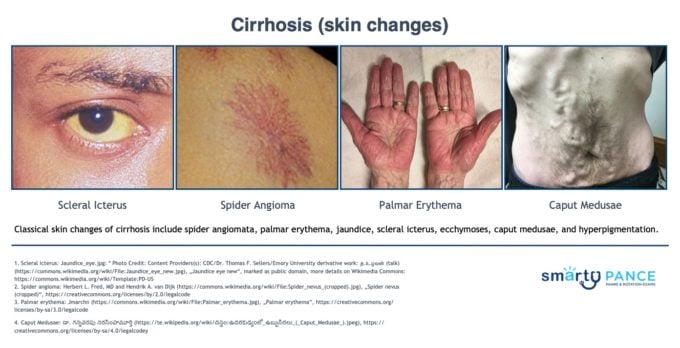 Cirrhosis - skin changes