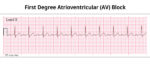 Conduction Disorders (PEARLS) - Smarty PANCE