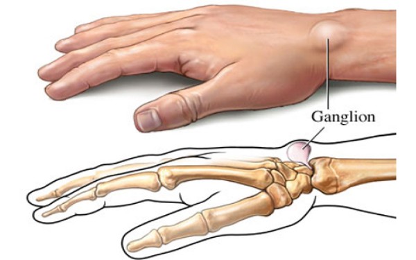 Ganglion-Cyst-Treatment-in-NYC
