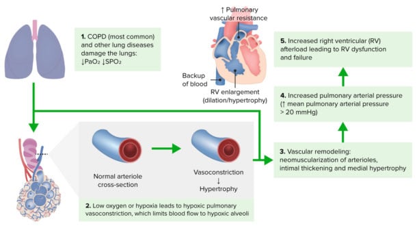 Cor pulmonale - Smarty PANCE