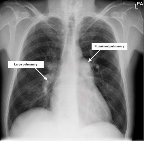 Pulmonary HTN