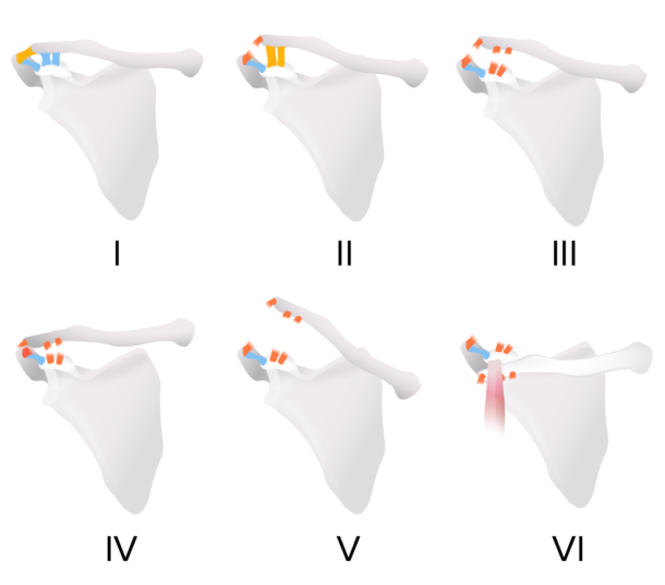 Soft Tissue Injuries of the Shoulder | Musculoskeletal Blueprint ...