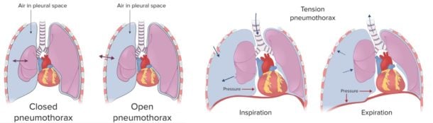 Pneumothorax (ReelDx) - Smarty PANCE