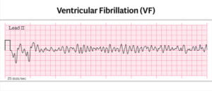 Ventricular Fibrillation (image by Adobe Stock)