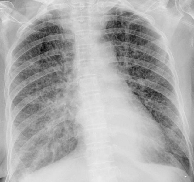 CXR showing typical findings of bilateral interstitial infiltrates