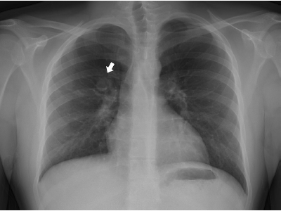 Carcinoid tumors - Smarty PANCE