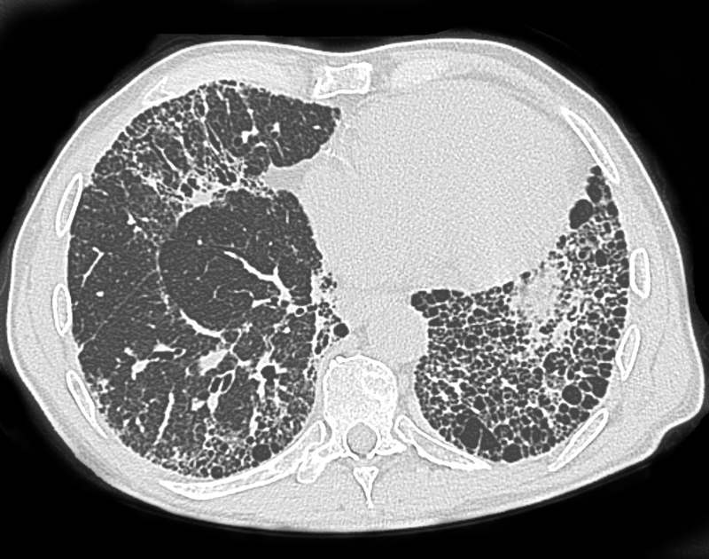 Chest CT showing classic "honeycombing"