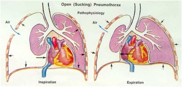 open_sucking_pneumothorax1327819647872