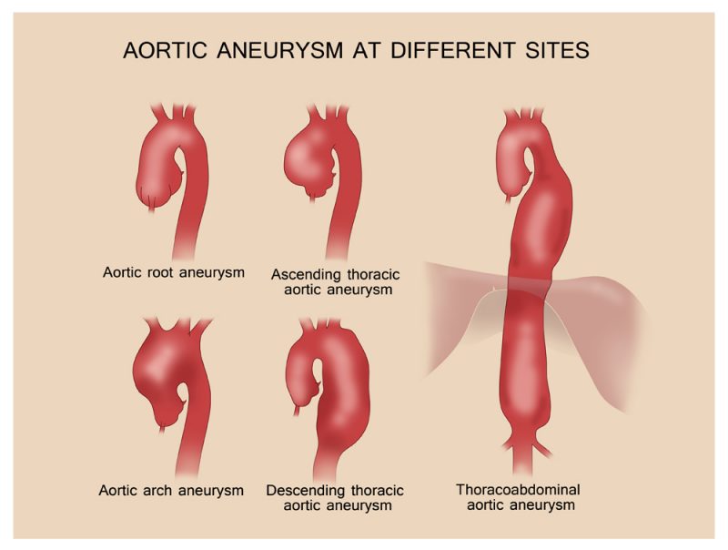 abdominal-aortic-aneurysm-size-chart