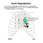 Aortic Regurgitation Murmur Auscultation