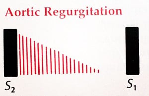 Aortic-Regurgitation-Waveform-2