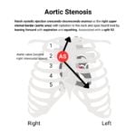 Aortic Stenosis (AS) Murmur Auscultation