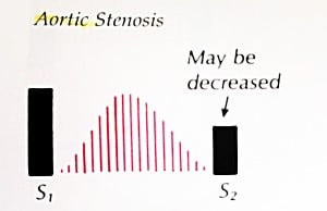 Aortic-Stenosis-Waveform