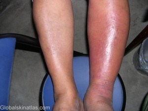 Cellulitis with erythematous tender swelling of the left lower extremity