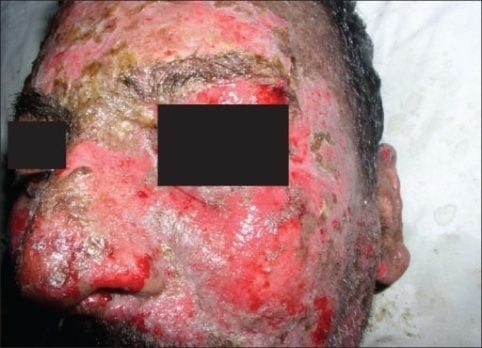 Characteristic lesions of SJS/TEN in a patient with accompanying erythema and sloughing.