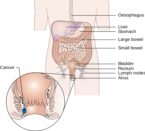 Diagram showing stage 1 anal cancer
