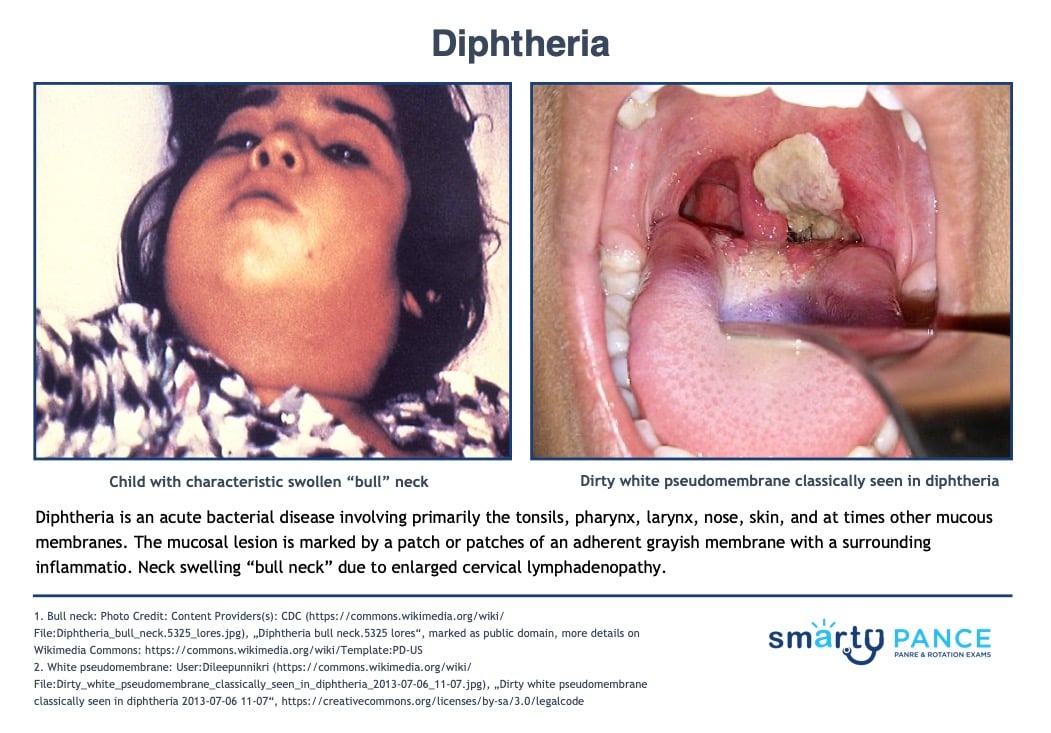 diphtheria bull neck