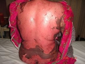 Drug-induced toxic epidermal necrolysis with peeled skin over the back and buttocks