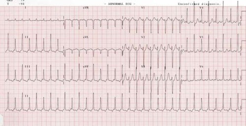 Electrical alternans as seen by changing QRS amplitudes best seen in lead II