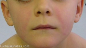 Erythema infectiosum (fifth disease): Symmetrical bright red cheeks, the rash does not extend over the bridge of the nose or around the mouth