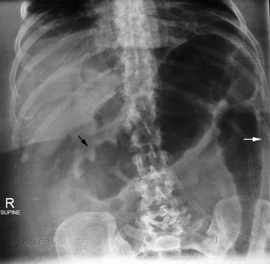 This patient has evidence of toxic megacolon involving the transverse colon and descending colon.