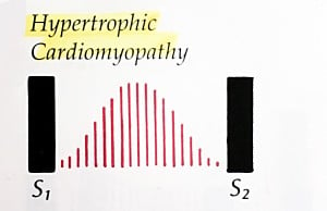 Hypertrophic-Cardiomyopathy-Waveform