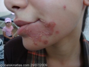 Impetigo with crusted patches around the mouth. 