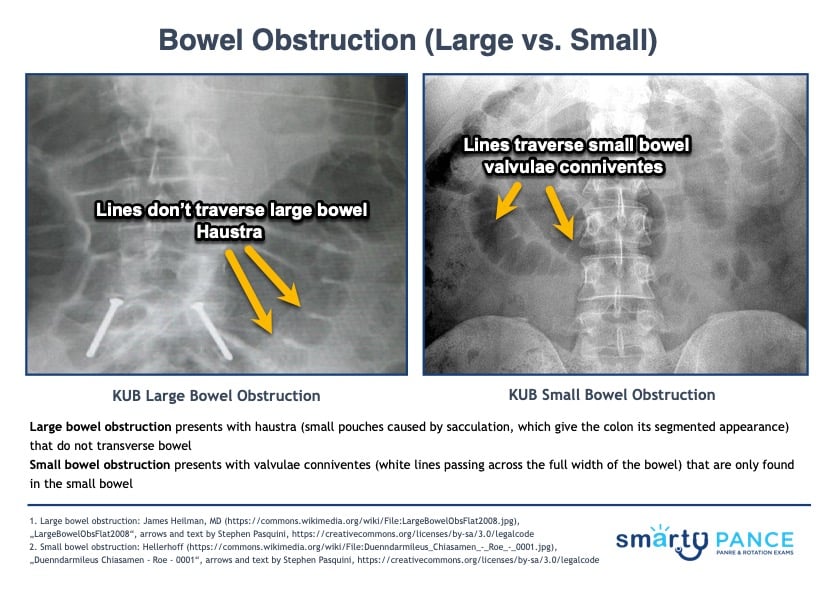 Large Bowel Obstruction vs Small Bowel Obstruction