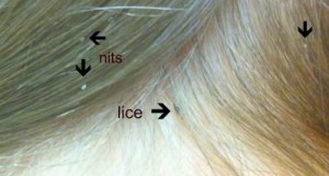 Lice and nits on the scalp