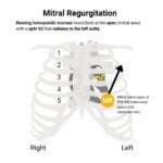 Mitral Regurgitation (MR) Murmur Auscultation