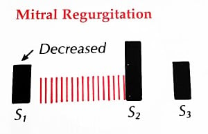 Mitral-Regurgitation-Waveform