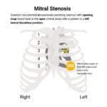 Mitral Stenosis (MS) Murmur Auscultation
