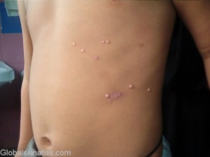 Molluscum contagiosum - Pearly papules with central umbilication