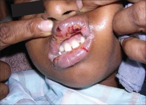 Oral lesions from SJS seen in a patient on an antiretroviral medication (nevirapine)