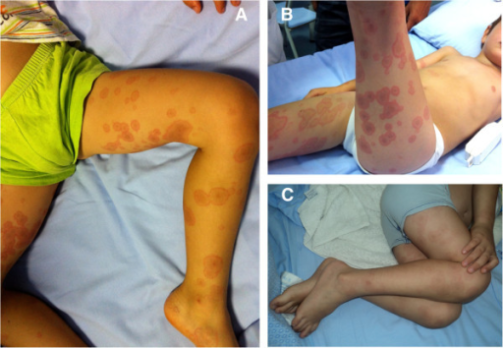 Erythema multiforme as first sign of incomplete Kawasaki disease