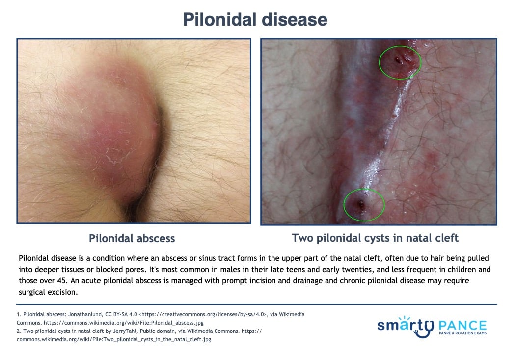 https://smartypance.com/wp-content/uploads/2015/12/Pilonidal-disease.jpg