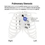 Pulmonary Valve Stenosis (PS) Murmur Auscultation